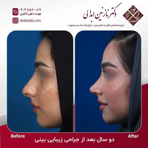 جراحی-بینی-633