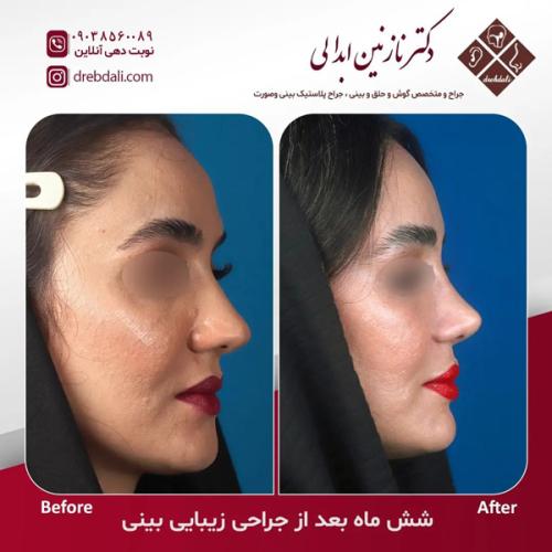 جراحی-بینی-634