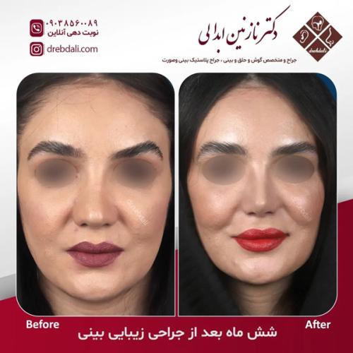 جراحی-بینی-635