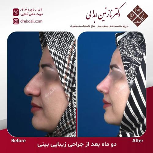 جراحی-بینی-636