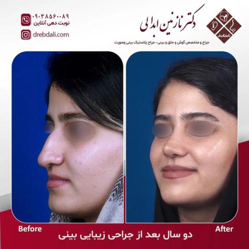 جراحی-بینی-637
