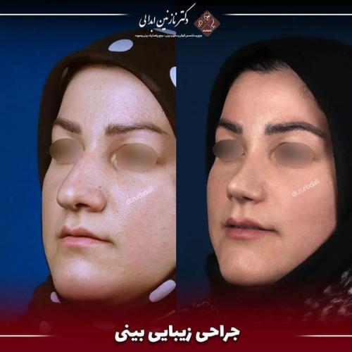 جراحی-بینی-640
