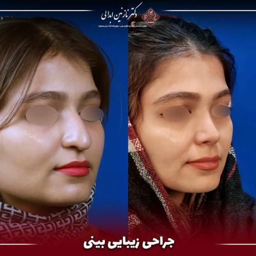 جراحی-بینی-641