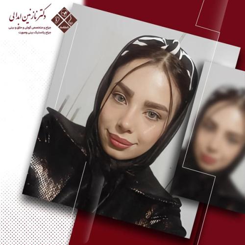 جراحی-بینی-642