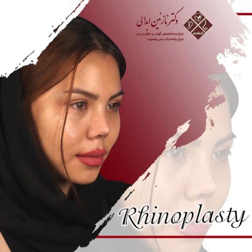 جراحی-بینی-643