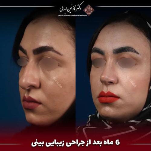 جراحی-بینی-645