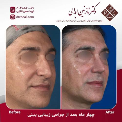 جراحی-بینی-647