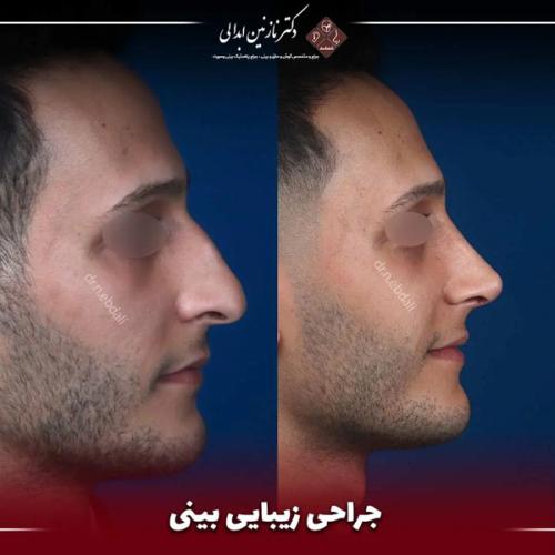 جراحی-بینی-664