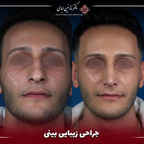 جراحی-بینی-665