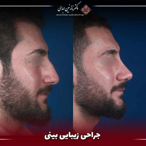 جراحی-بینی-666