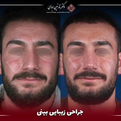 جراحی-بینی-667
