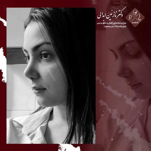 جراحی-بینی-668