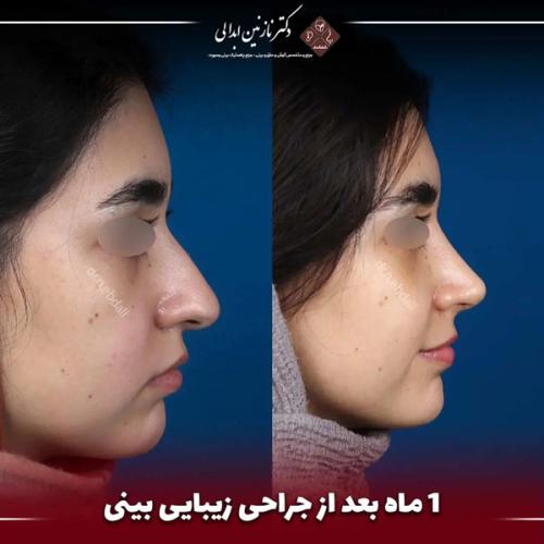 جراحی-بینی-670 (1)
