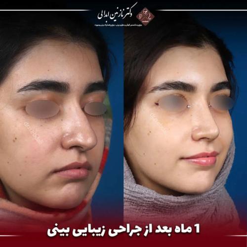 جراحی-بینی-671 (1)