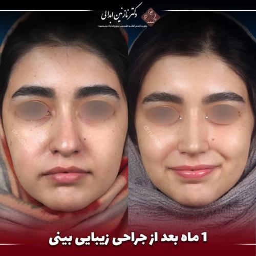 جراحی-بینی-672