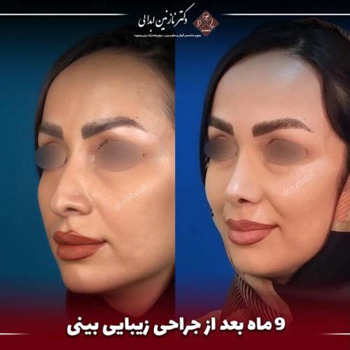 جراحی-بینی-673