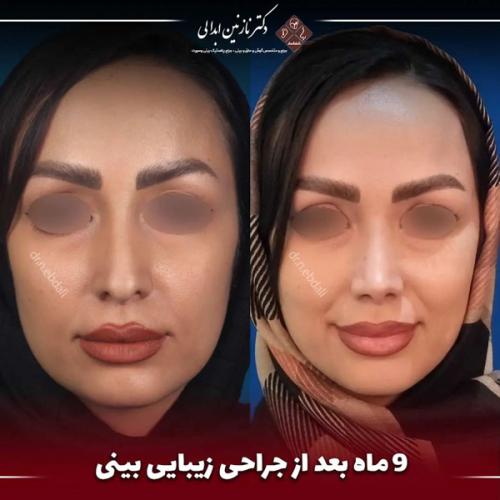 جراحی-بینی-674