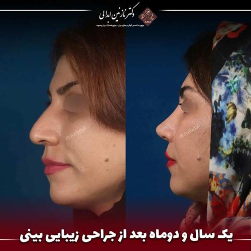 جراحی-بینی-676