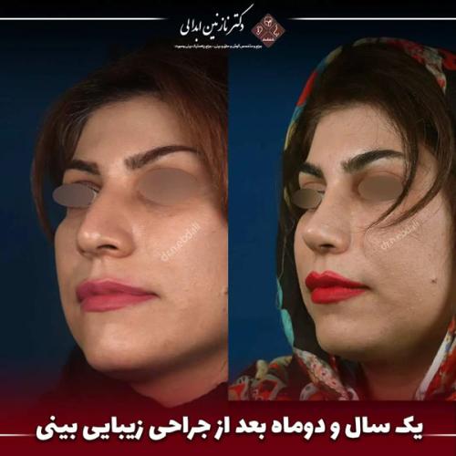 جراحی-بینی-677