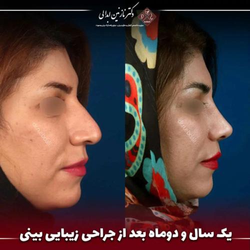 جراحی-بینی-678