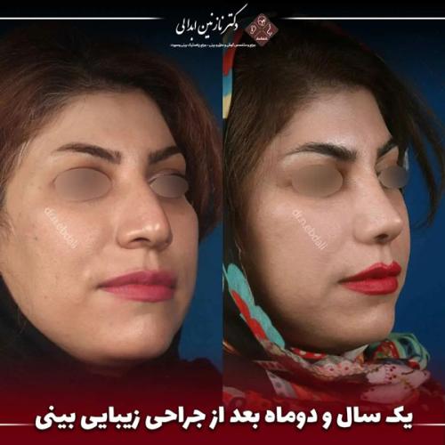 جراحی-بینی-679