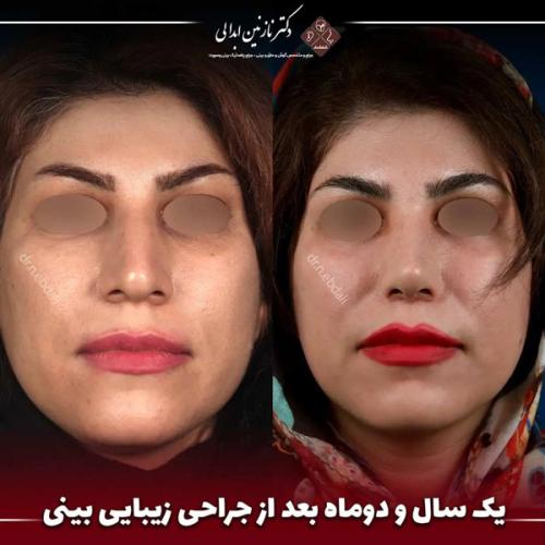 جراحی-بینی-680