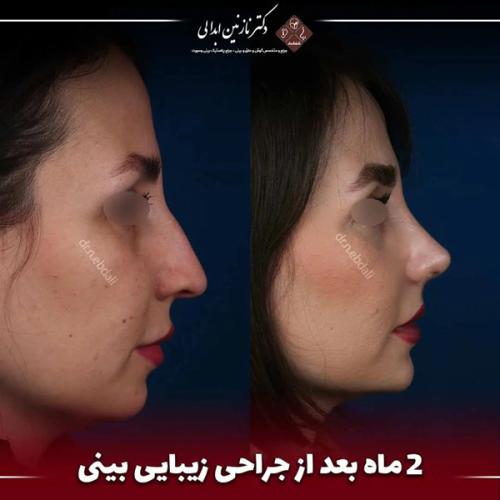 جراحی-بینی-683