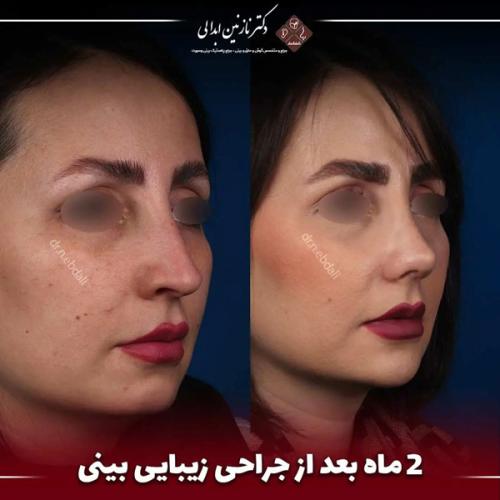 جراحی-بینی-684