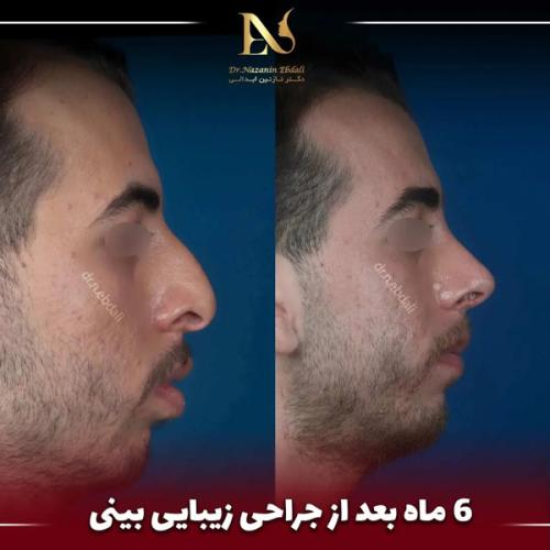 جراحی-بینی-693