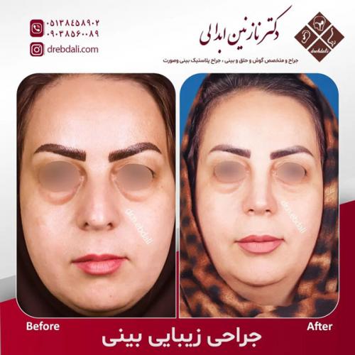 جراحی-بینی566