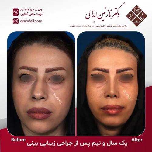 جراحی-بینی619