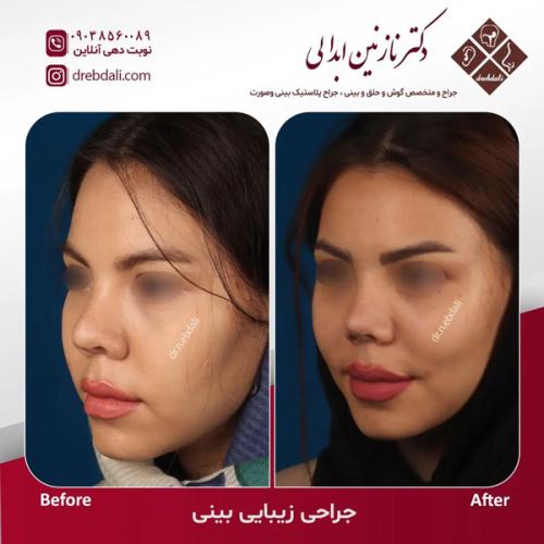 جراحی-بینی620