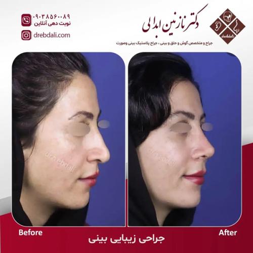 جراحی-بینی626