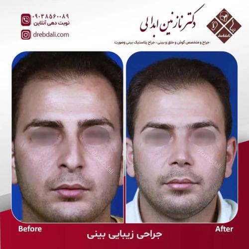 جراحی-بینی628