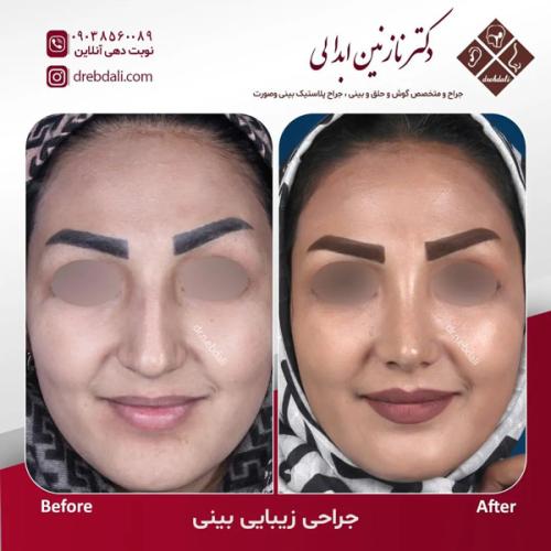 جراحی-بینی629