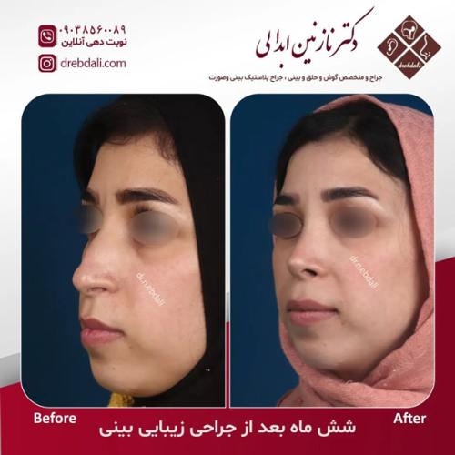 جراحی-بینی630