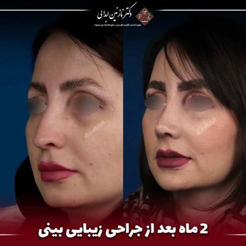 جراحی-بینی681