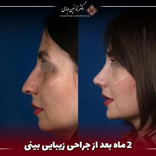 جراحی-بینی682