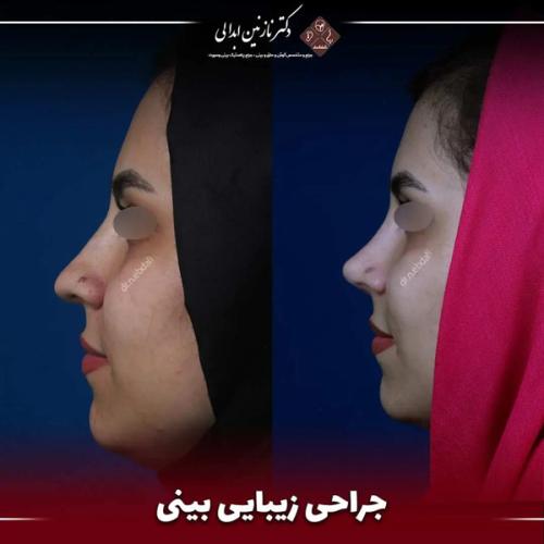 جراحی-بینی685