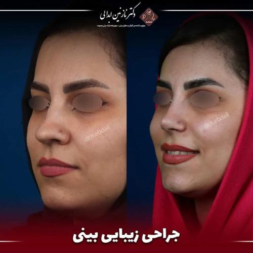 جراحی-بینی686