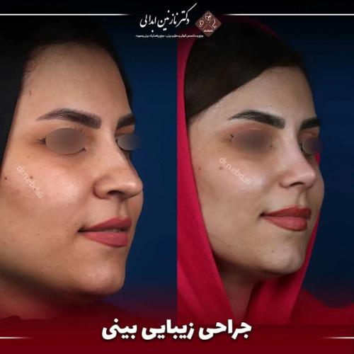 جراحی-بینی687