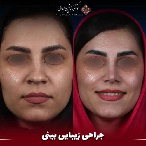 جراحی-بینی688