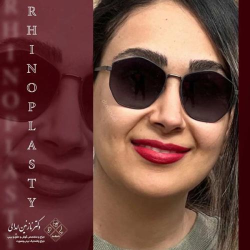 جراحی-بینی689