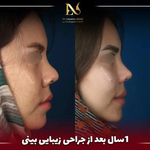 جراحی-بینی690