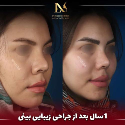 جراحی-بینی691