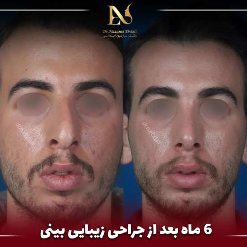 جراحی-بینی694