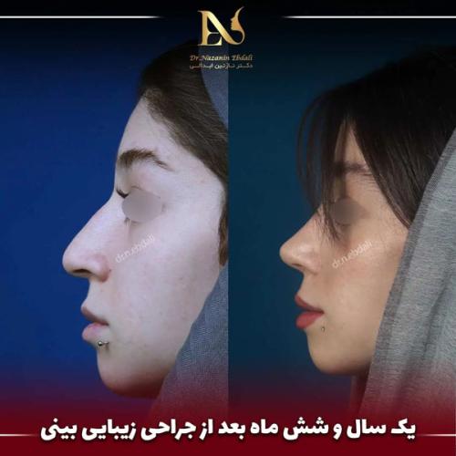 جراحی-بینی695